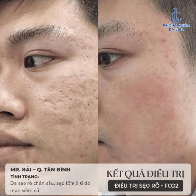 Vì sao Phòng khám Da liễu LG giữ vững vị trí top 1 điều trị sẹo rỗ tại TP.HCM?